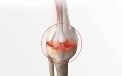 Est-il possible de marcher avec une fissure du ménisque ?