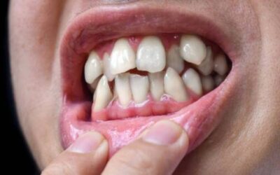 L’encombrement dentaire chez les adultes