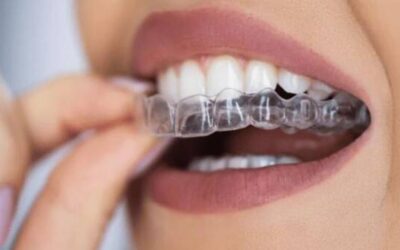 Aligneurs transparents : la révolution discrète de l’orthodontie moderne